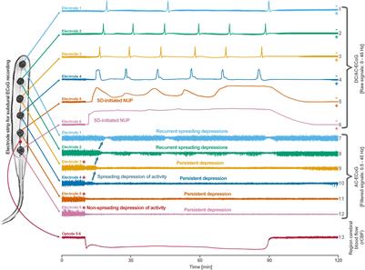 Migraine Aura, Transient Ischemic Attacks, Stroke, and Dying of the Brain Share the Same Key Pathophysiological Process in Neurons Driven by Gibbs–Donnan Forces, Namely Spreading Depolarization